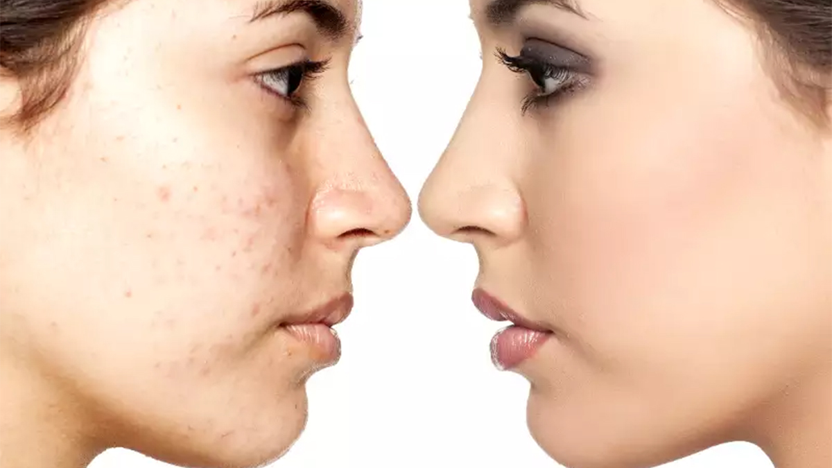 بهترین روش‌های درمان و پیشگیری از لک صورت