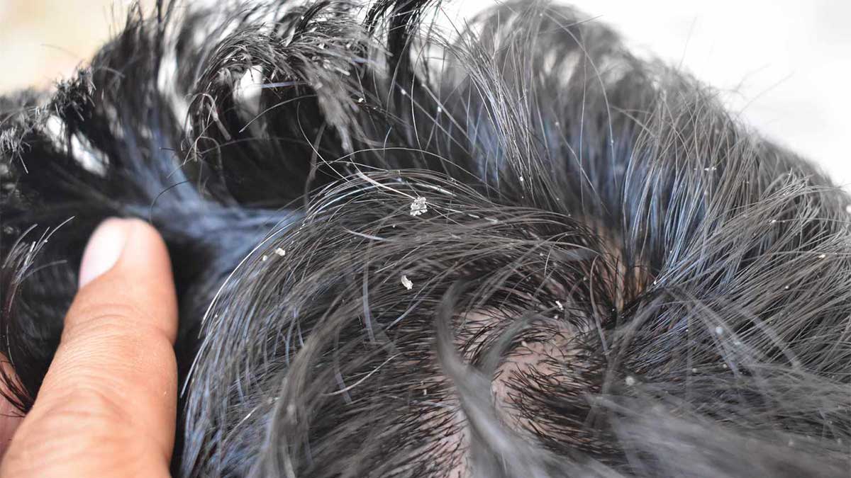 انواع مختلف شوره سر و دلایل ایجاد آن‌ها