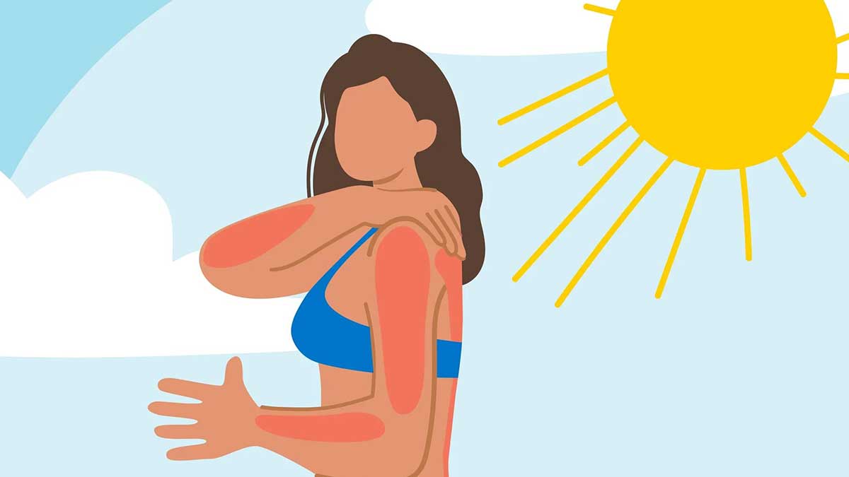 تسکین فوری پوست آفتاب‌سوخته