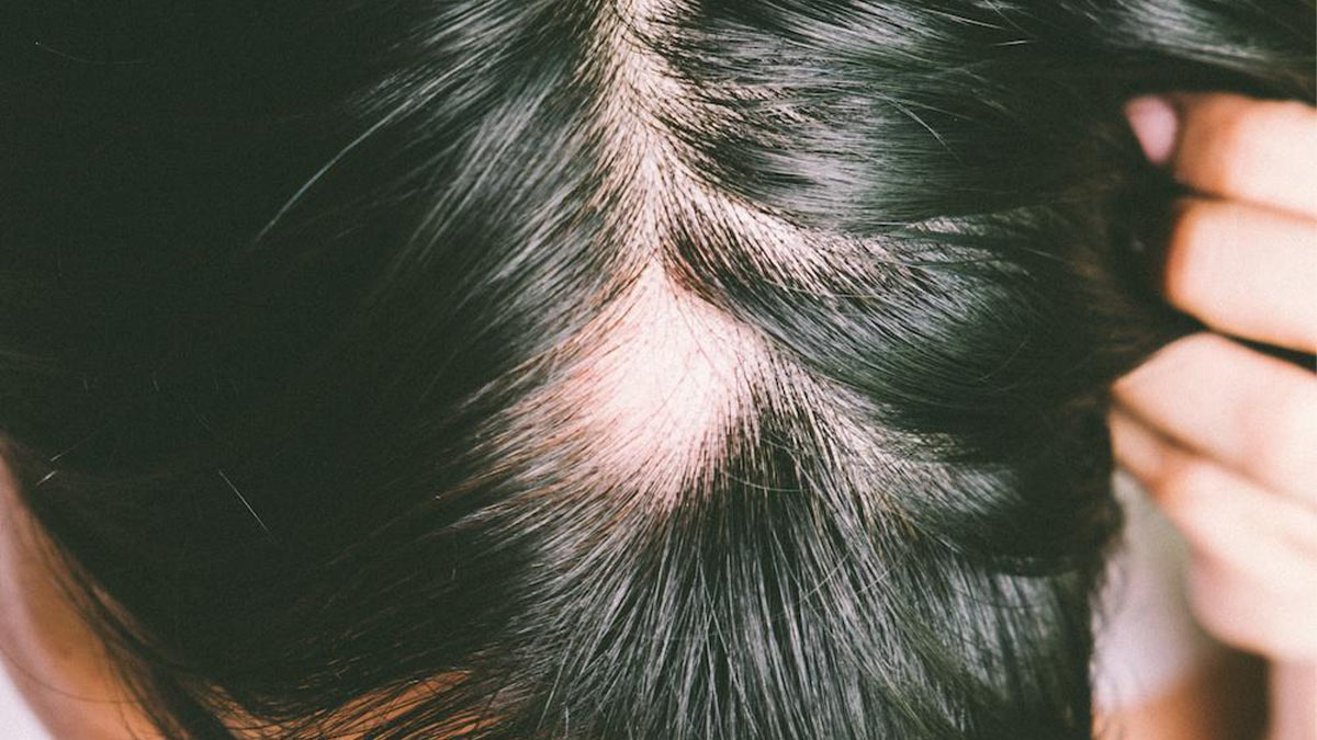 تاثیر تغییرات هورمونی بر سلامت مو + پیشگیری و درمان