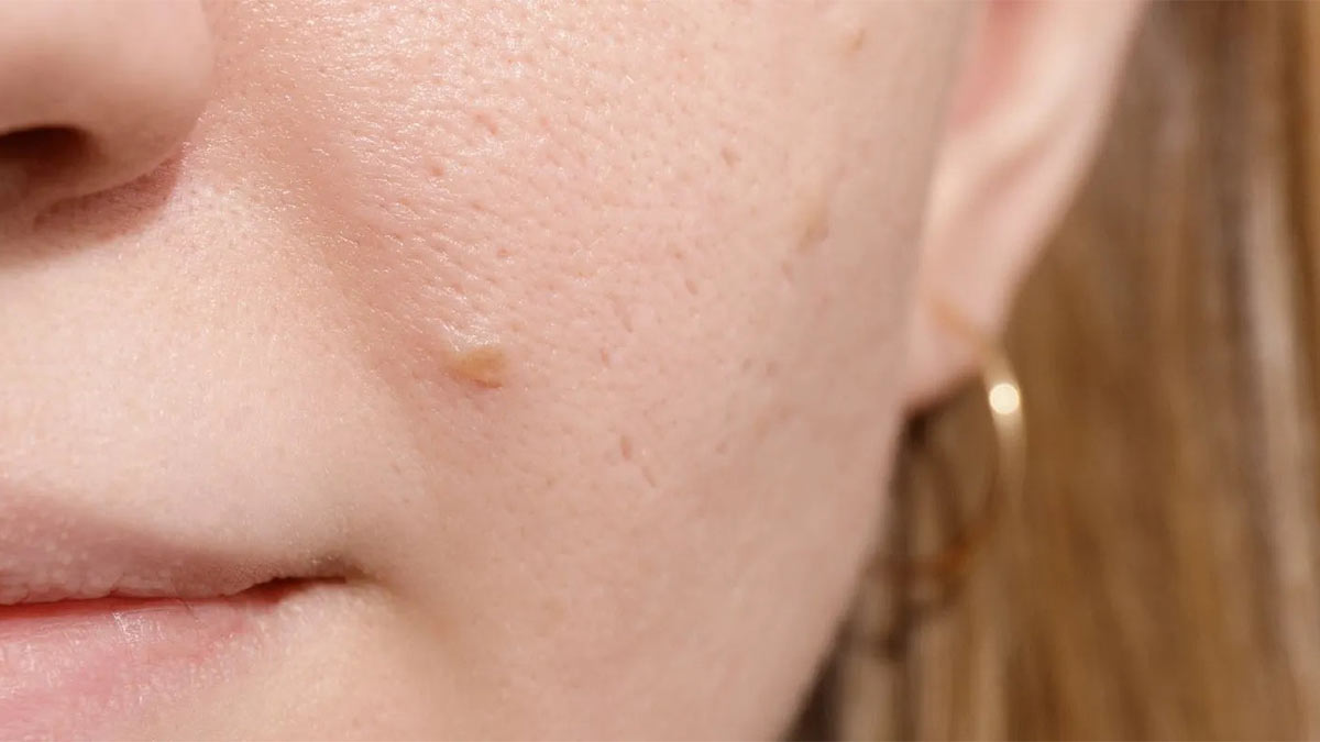 درک پوست خشک، علل، علائم و اهمیت مراقبت