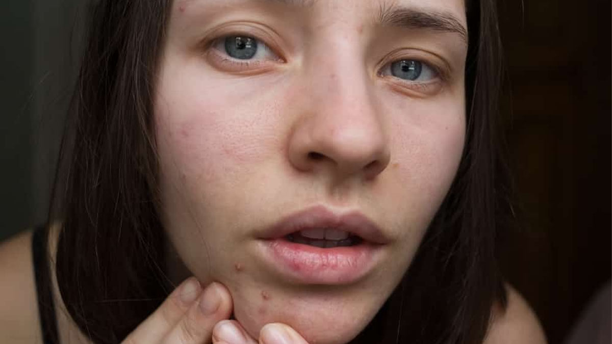 هورمون‌ها چگونه بر پوست تأثیر می‌گذارند؟