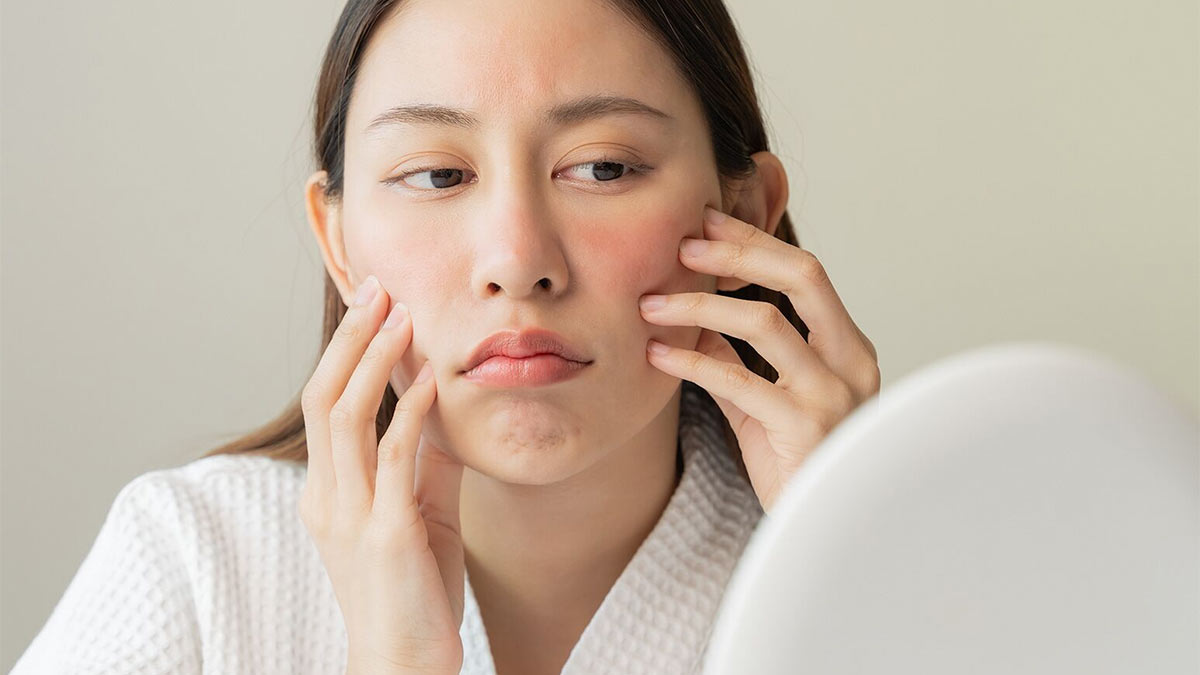 پیشگیری از مشکلات پوستی ناشی از تغییرات هورمونی