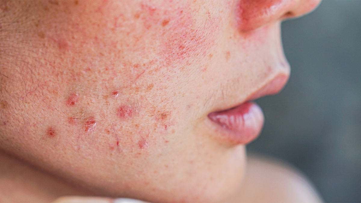 علائم آسیب سد دفاعی پوست + راهکارهای بازسازی