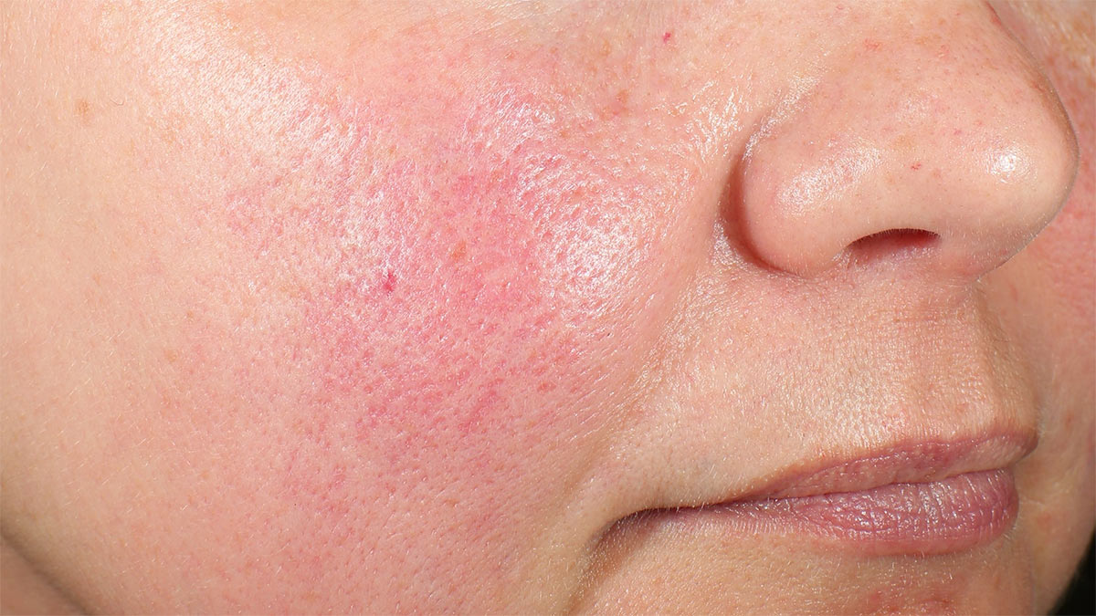 علائم آسیب سد دفاعی پوست