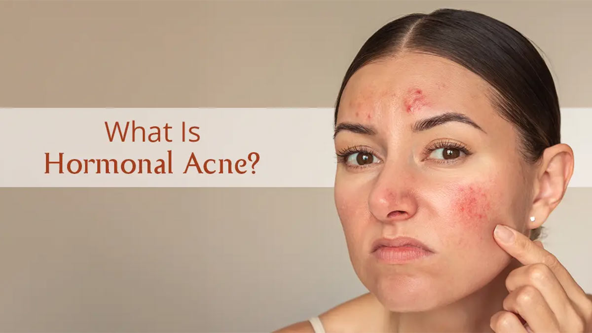 آکنه هورمونی چیست و چه محصولاتی واقعاً مؤثرند؟