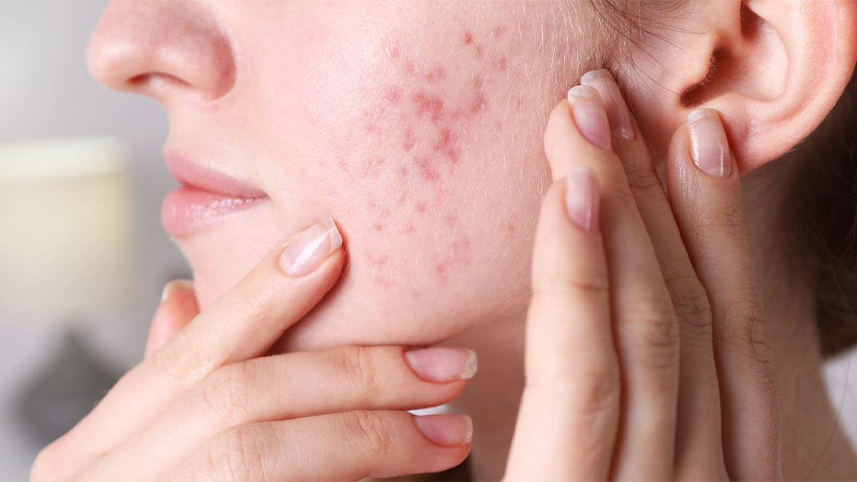 آکنه هورمونی چیست؟