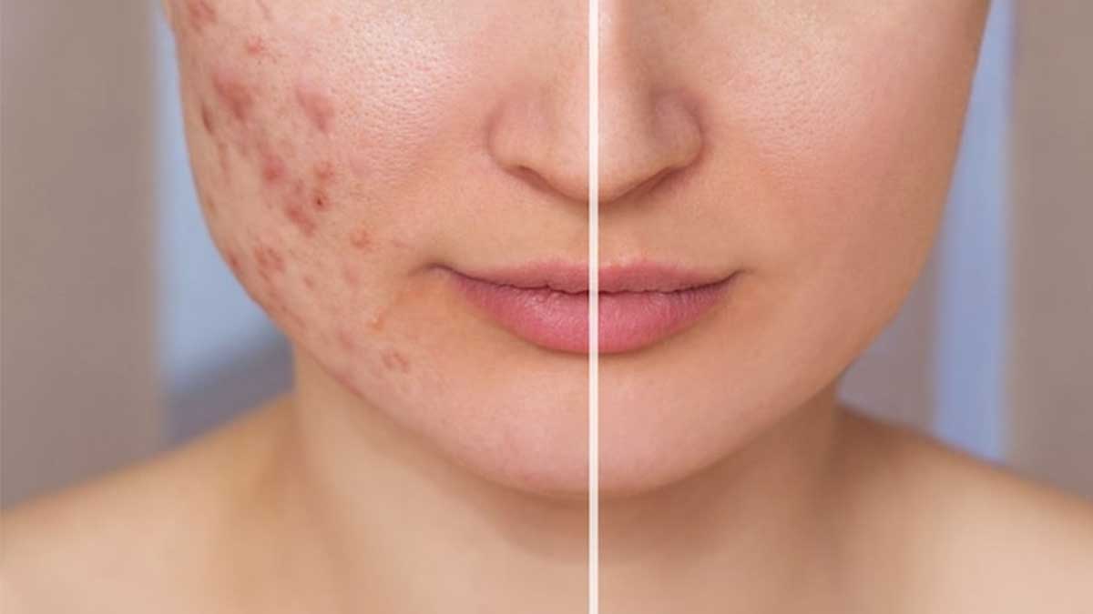 درمان لک پوستی بعد از جوش | چرا بعضی لک‌ها محو نمی‌شوند؟