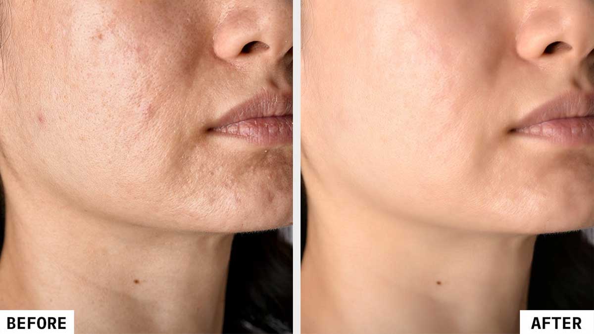 روش‌های موثر درمان لک پوستی بعد از جوش