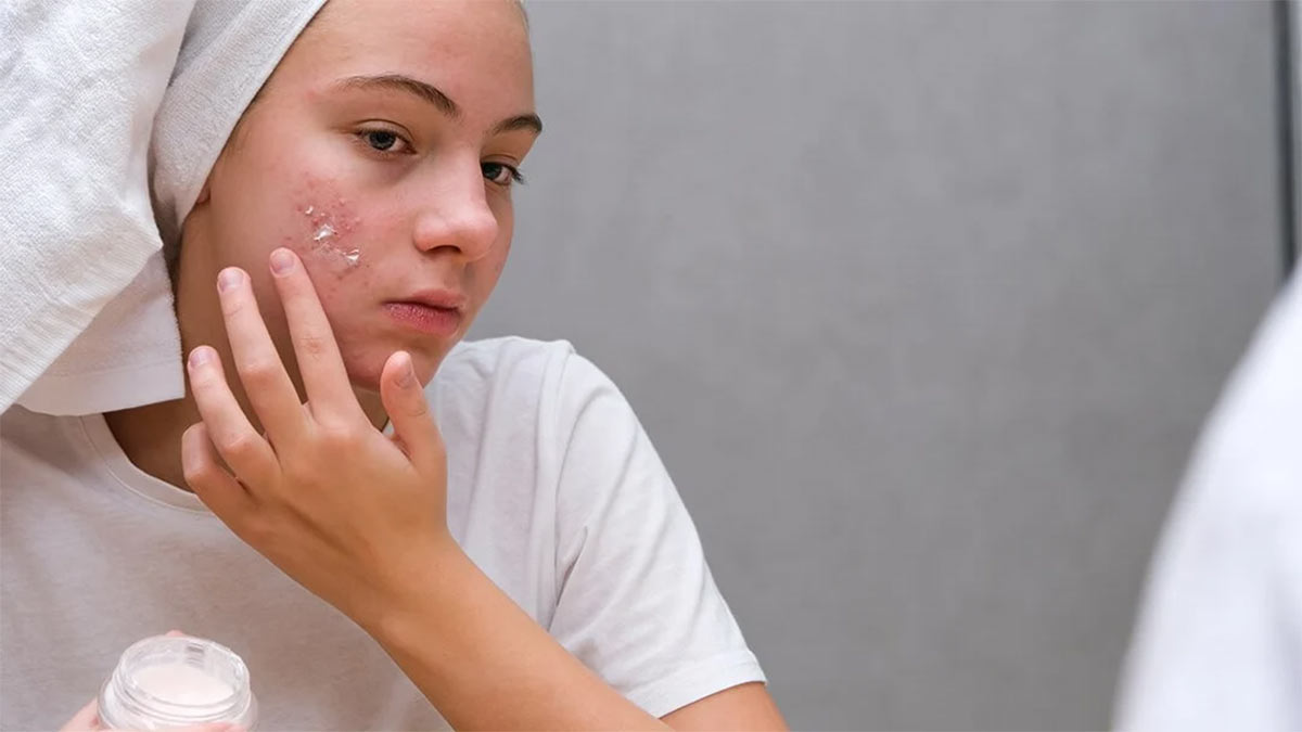 محصولات و درمان‌های مؤثر برای آکنه هورمونی