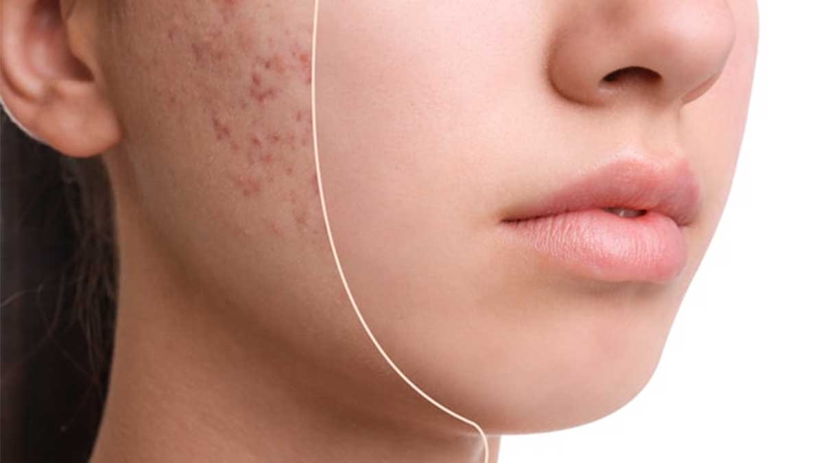 پیشگیری و مراقبت‌های روزانه برای جلوگیری از بازگشت لک‌ها